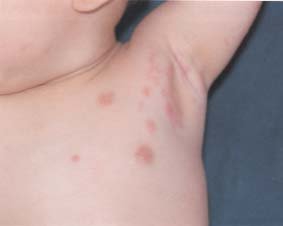 初期 帯状疱疹