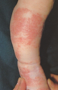 atopic_dermatitis02.jpg