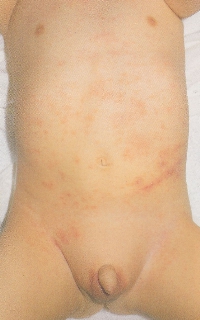 atopic_dermatitis03.jpg