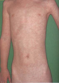 measles02.jpg