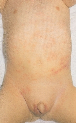 atopic_dermatitis03.jpg