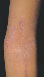 atopic_dermatitis05.jpg