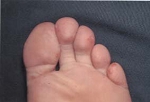 hand-foot-mouth-02.jpg