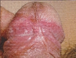 balanoposthitis01.jpg