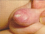 balanoposthitis02.jpg